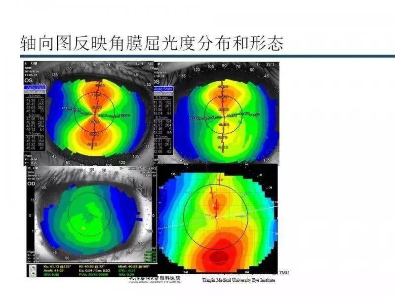 角膜地形图的作用图片