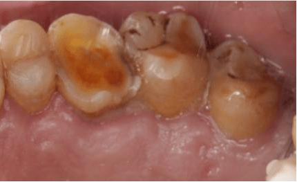 "酸牙,倒牙"别紧张——牙医带你认识牙本质敏感症_治疗_牙膏_牙齿