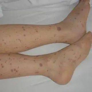 水疱型皮肤病变占新冠病毒感染相关皮肤损害的10