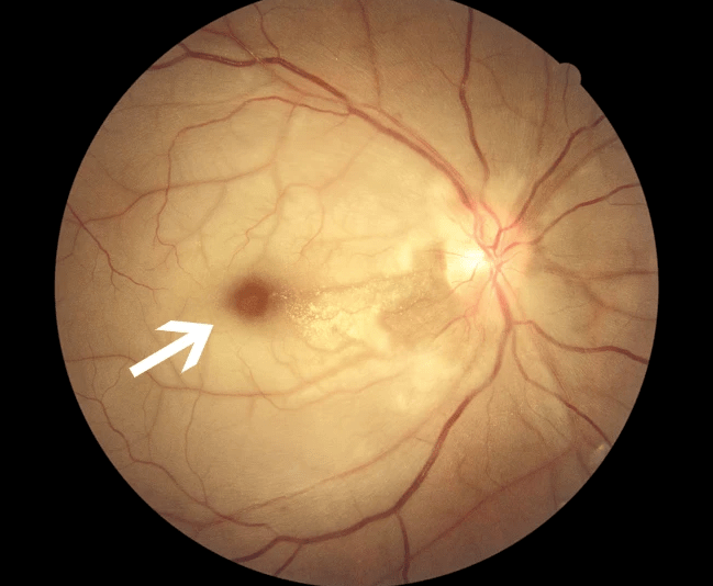 11种常见眼底病,你都了解了吗?_视网膜_患者_彩照