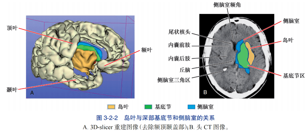 经外侧裂 - 岛叶入路基底节区脑出血清除术应用解剖（1）-人卫书摘