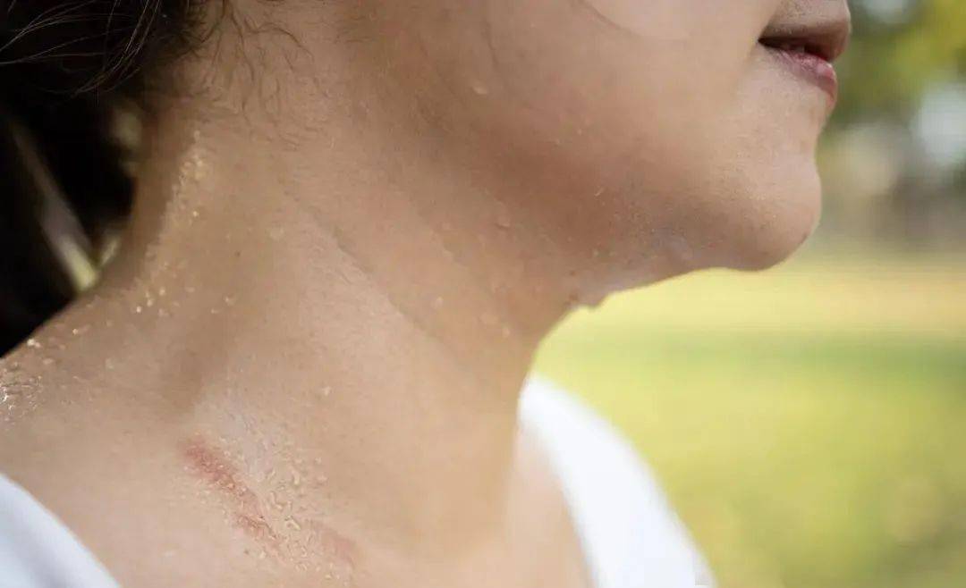 不运动都大汗淋漓?这些异常出汗的表现,都预警这什么问题?