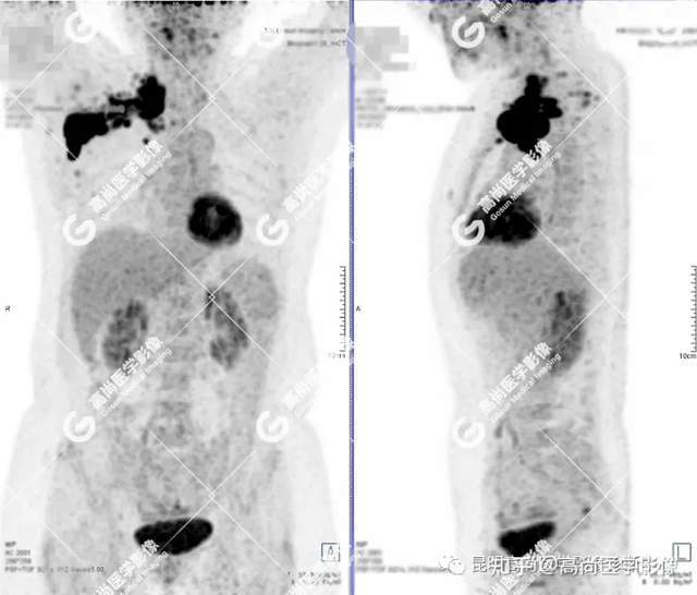 PET-CT诊断右侧副乳腺癌一例