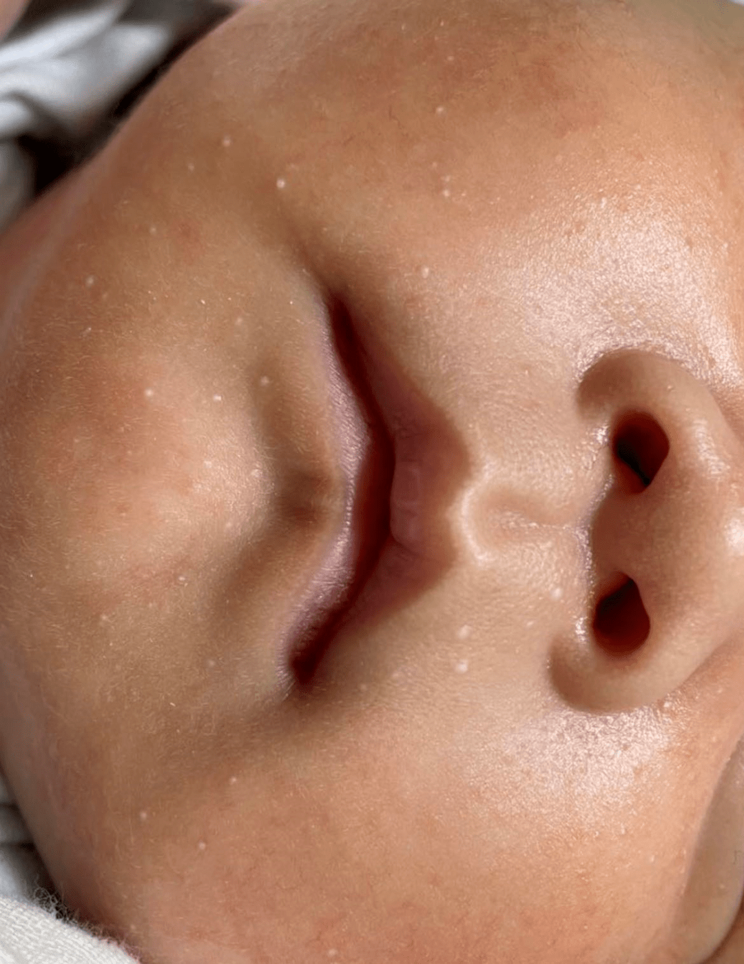 婴儿脂肪粒的原因（宝宝脸上长小白点）-幼儿百科-魔术铺