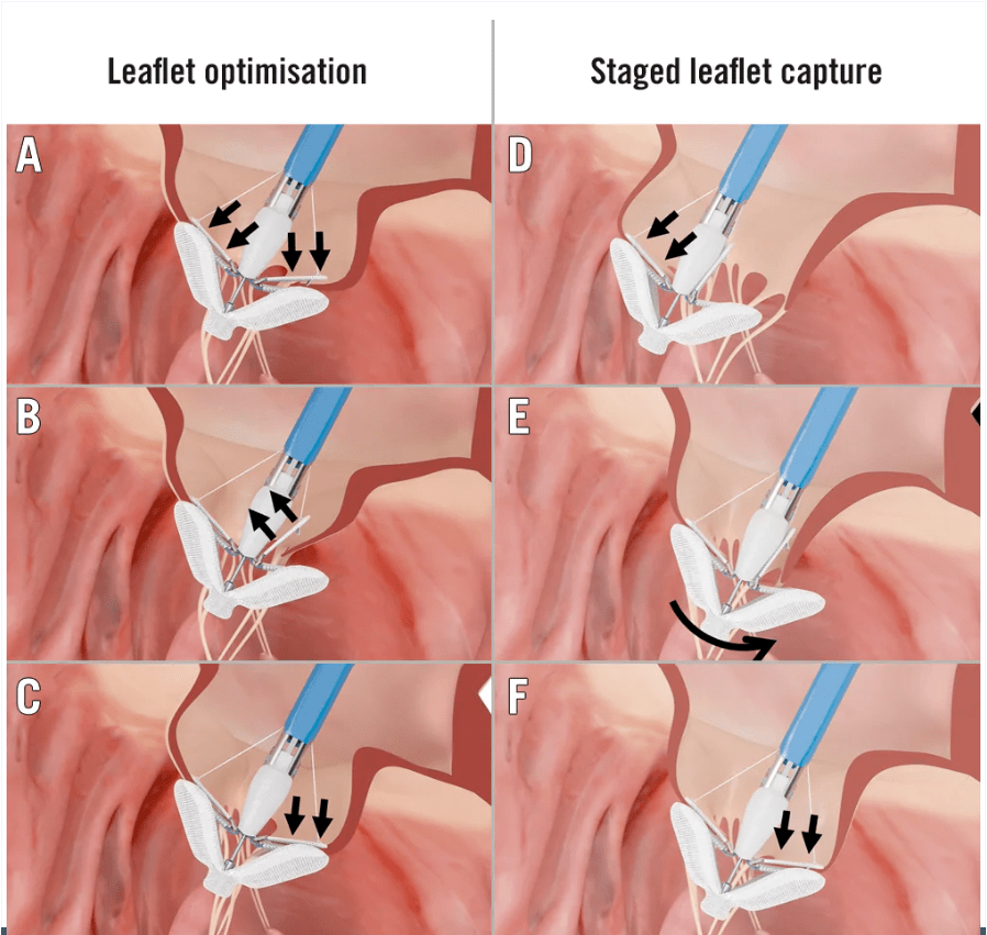eurointervention 2023年首篇综述聚焦m-teer,系统阐述
