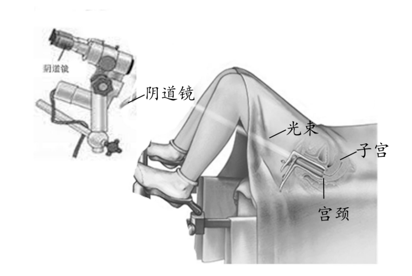 检查宫颈的步骤图片图片