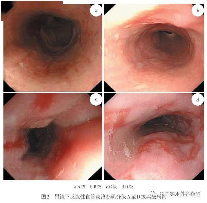 近端胃双通道图片