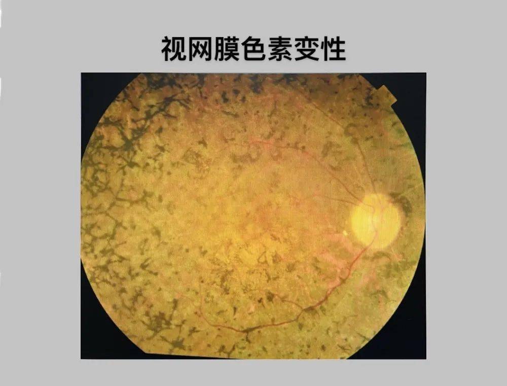 值得收藏 | 常见眼底照相图谱_视网膜_病变_阻塞