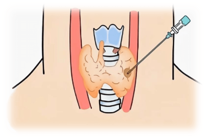 甲状腺穿刺怎么做图片