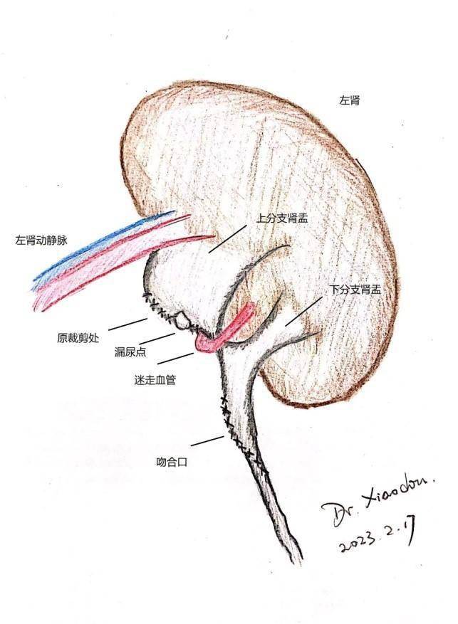 耿红全团队做了上下肾盂的吻合术,使得上下肾盂贯通并一起向输尿管