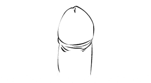 女友吐槽:你下面好大味!每次结束完都觉得痒痒的!_包皮_诊断_丁丁