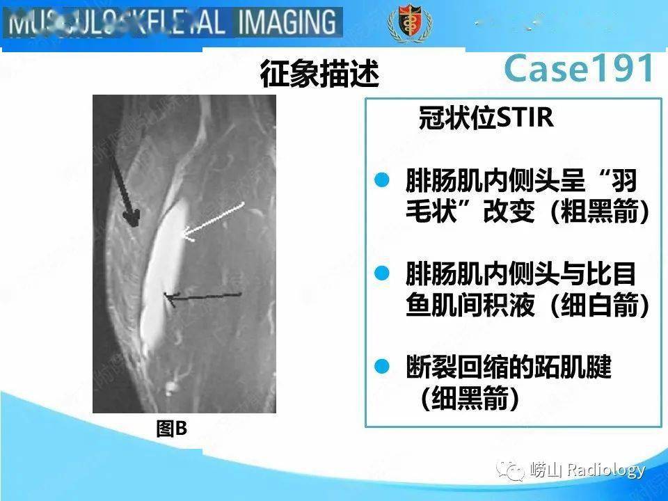 跖肌腱超声图片