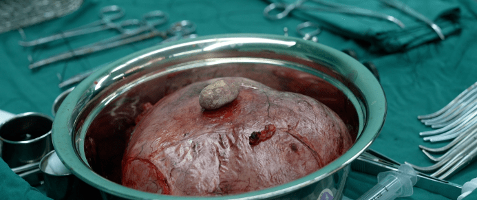 (左图为内镜下膀胱内瘘道,右图椭圆形为内镜下膀胱结石90)