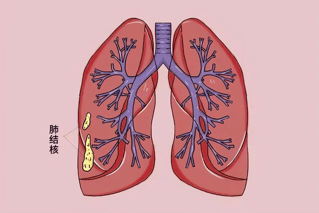 肺结核能治好吗图片