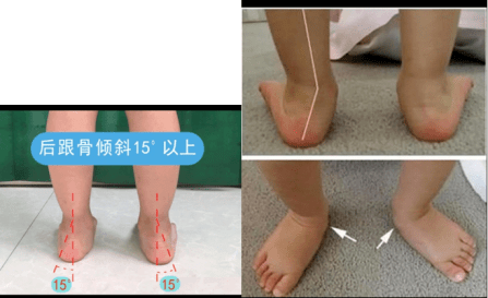 【科普】警惕小儿足外翻_孩子_儿童_治疗