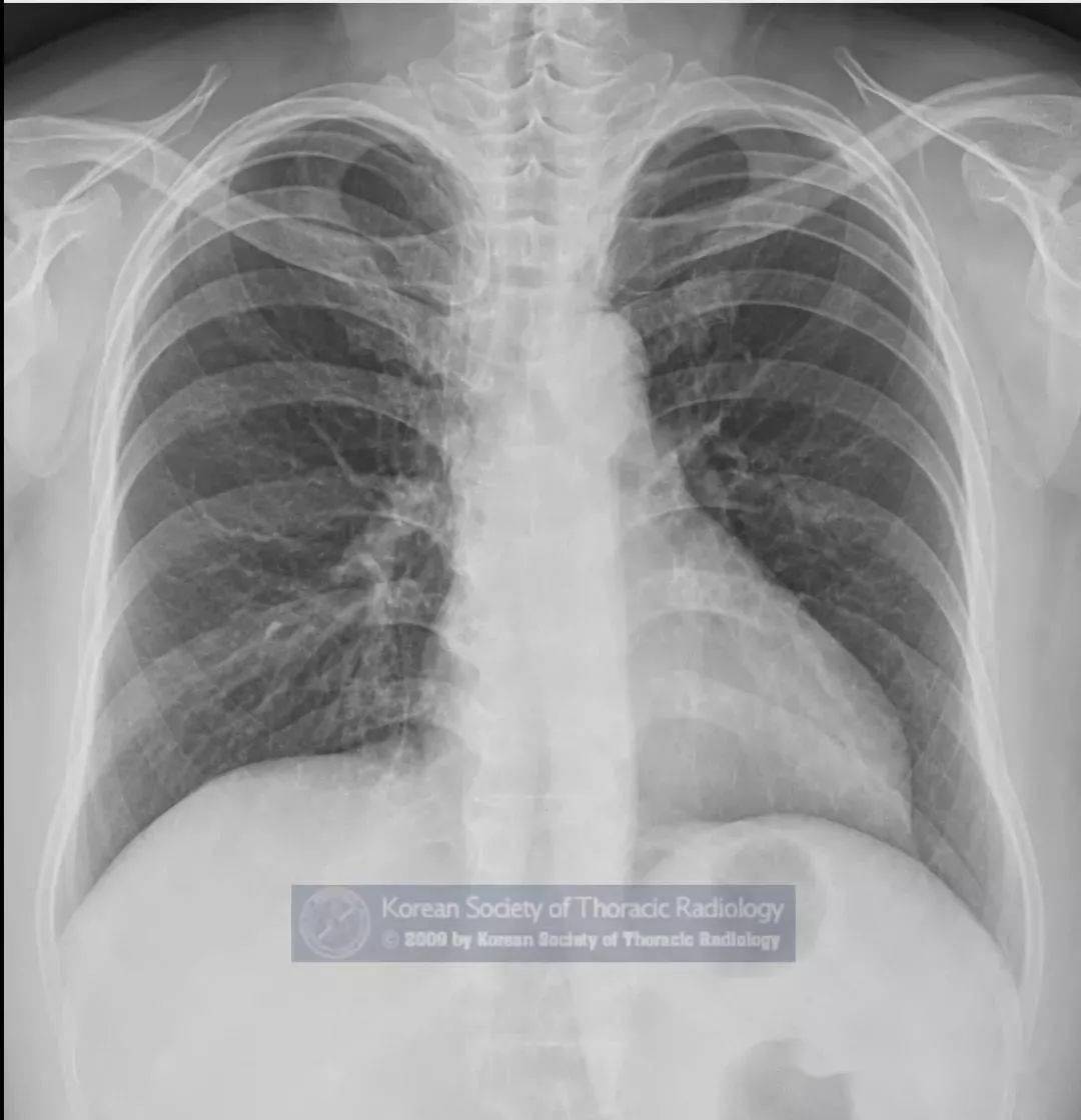 估计80%的医生都没听过这个肺部疾病,涨见识!