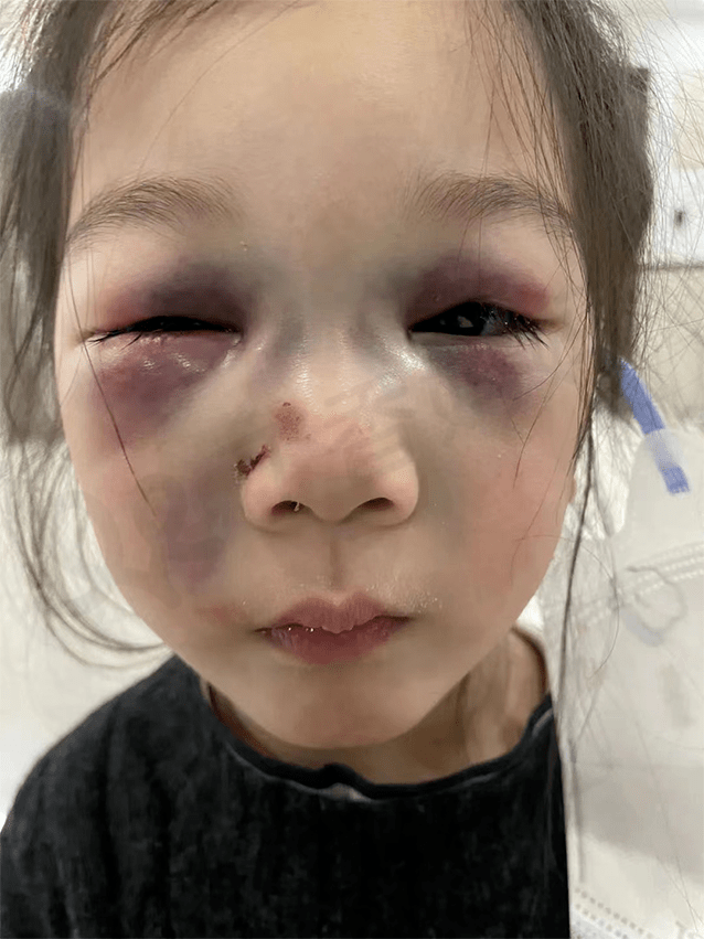 女儿在幼儿园摔了一跤,第二天眼睛周围开始渗血