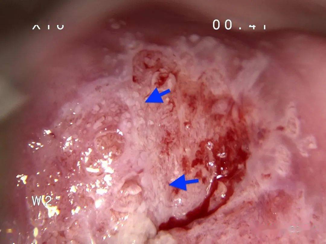 宫颈为1型转化区,可见醋酸白色上皮,点状血管,镶嵌和白色腺体,碘试验