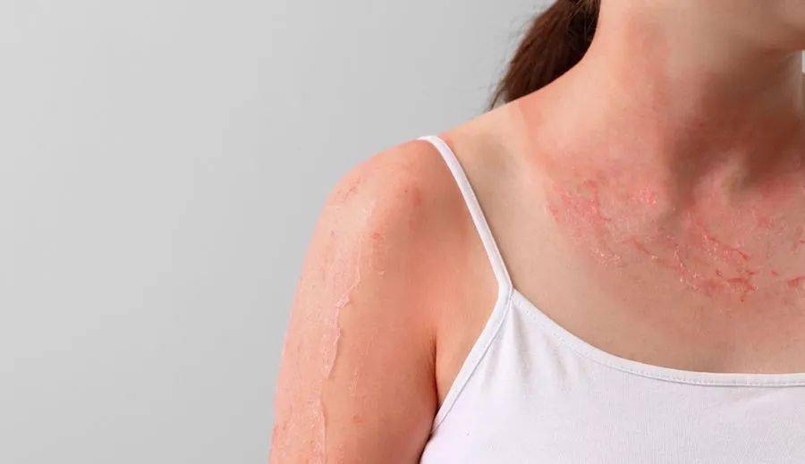 过敏还是风湿,一文看认清_症状_皮肤_面部