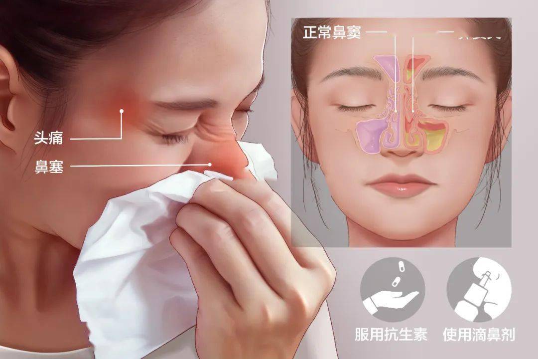 治疗_症状_鼻腔