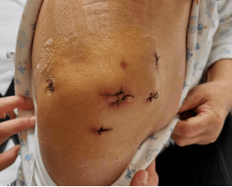 肩袖损伤不是肩周炎 骨三微创技术不平凡_运动_治疗_手术