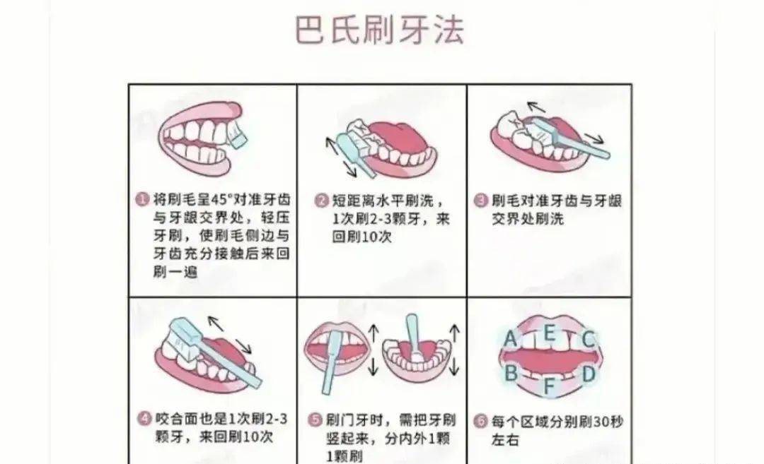 选择合适的牙刷,并配合正确的刷牙方式(巴氏刷牙法)是预防楔状缺损缺