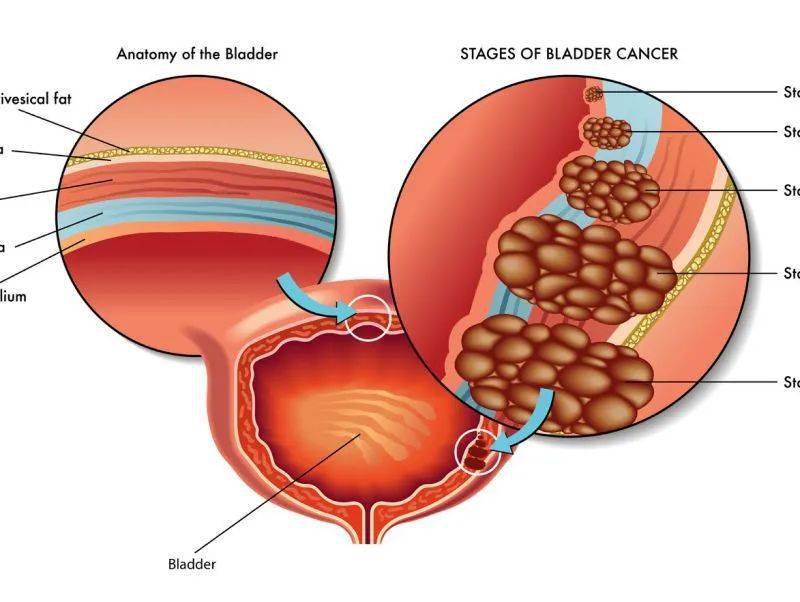 膀胱肿瘤的症状图片