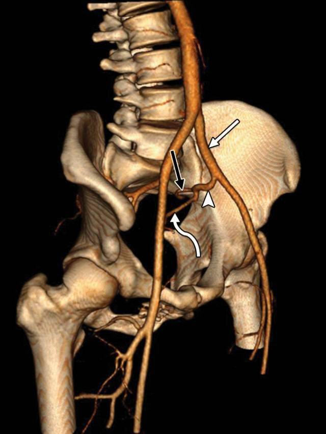 髂内动脉造影图谱图片
