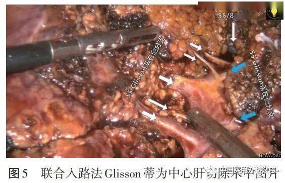 文献综述|glisson系统为中心腹腔镜肝切除临床应用进展_laennec_解剖
