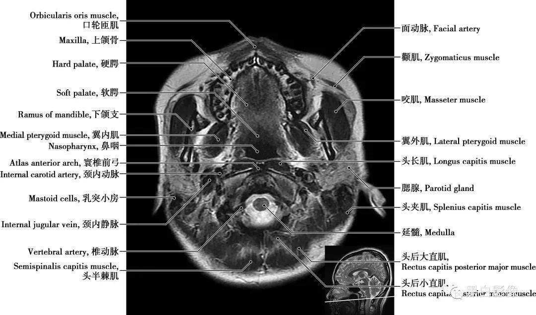 详细的颅脑MRI正常解剖图谱,收藏级!_大脑_纤维_部分