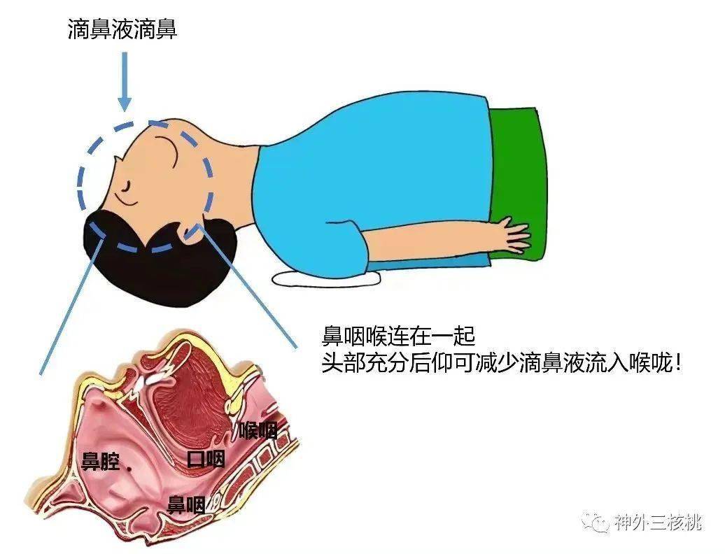 垂体瘤经鼻蝶手术患者需遵医嘱剪双侧鼻毛,术前遵嘱予抗生素滴鼻液