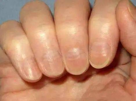 变软,变形等,甚至发黄,变粗糙等,并可能出现指甲下隆起或是指甲凹陷