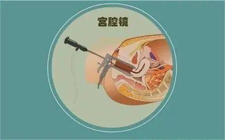 【妇幼科普】带你了解宫腔镜_手术_检查_子宫