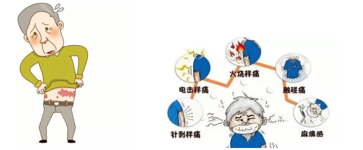 刺络拔罐放血—带状疱疹有良效_局部_神经_水疱