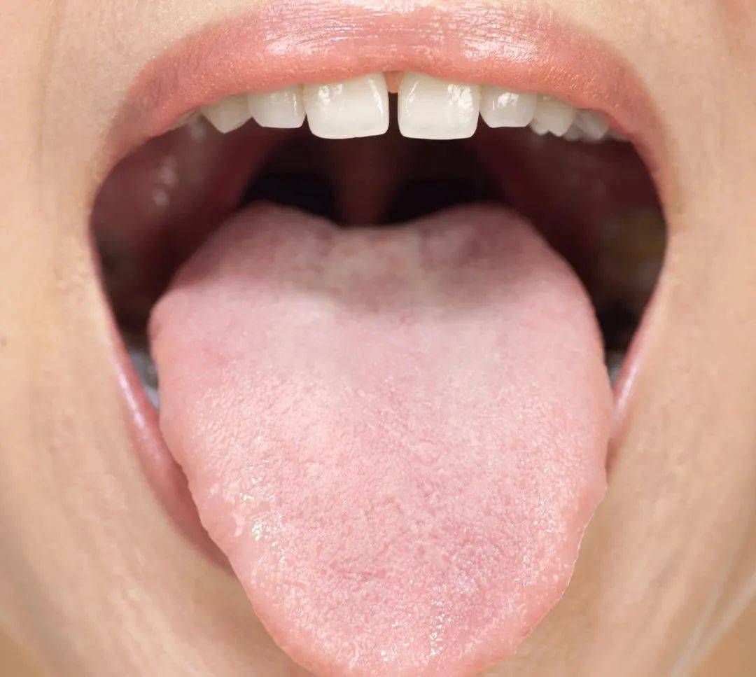 正常舌苔图片 女性图片