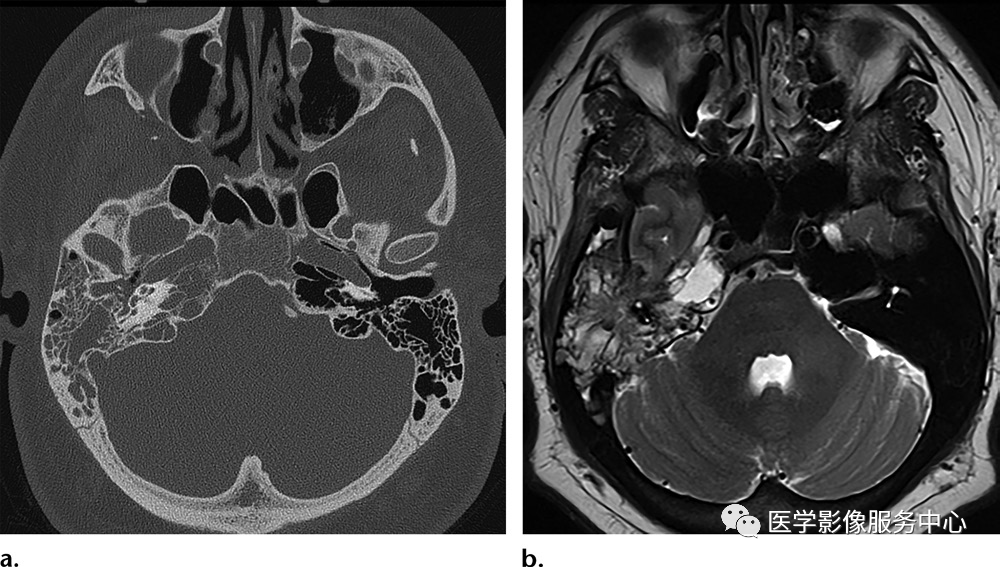 a图 轴位ct骨窗示右侧乳突气房