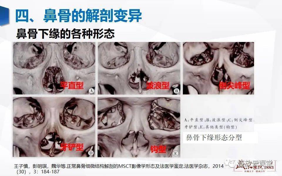 鼻骨正常图片图片