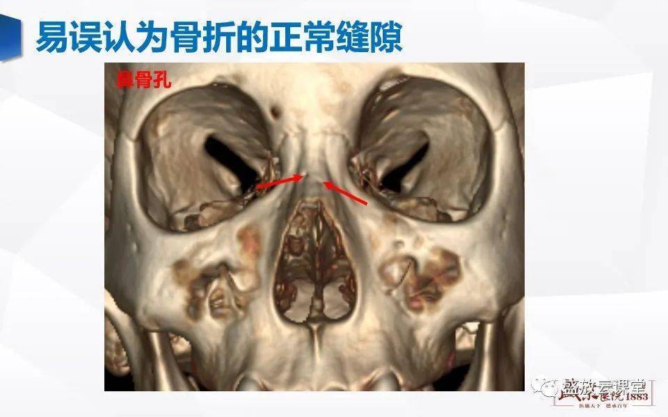 没有鼻骨正常人图片图片