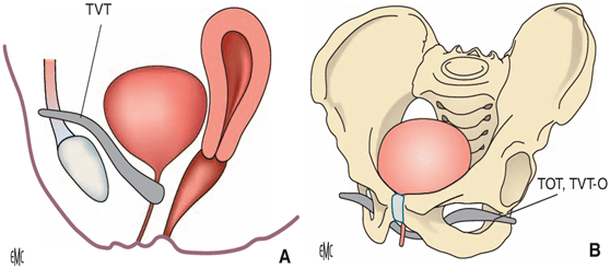 每三个妈妈,就有一个尿失禁_患者_治疗_女性