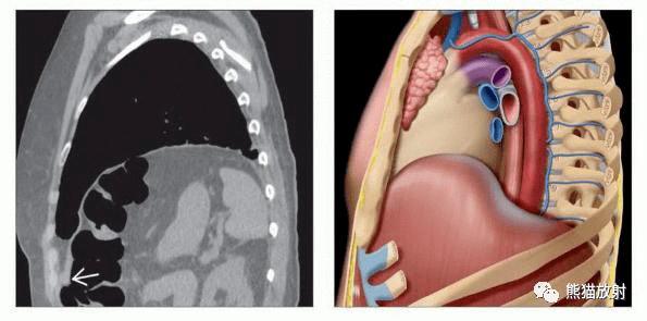 膈肌x线图片图片