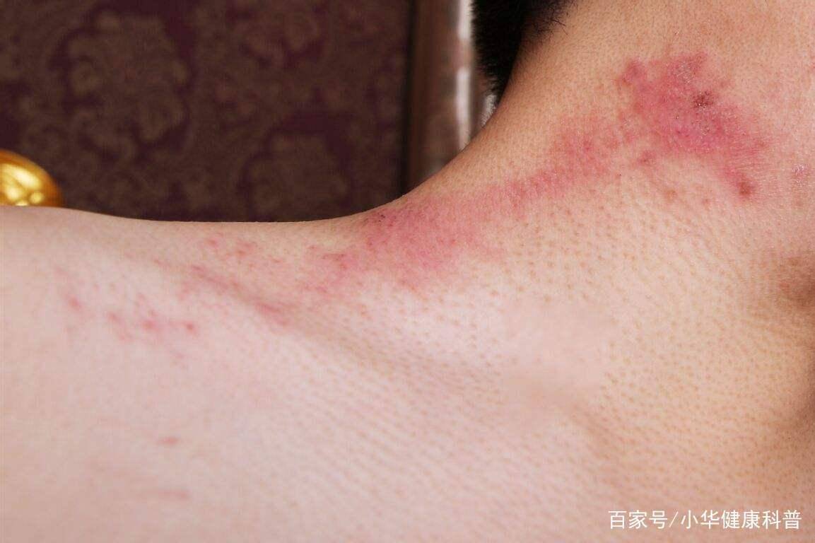 感染后有啥表现?这2种传播途径,男女都要小心_问题_寄生虫_人体