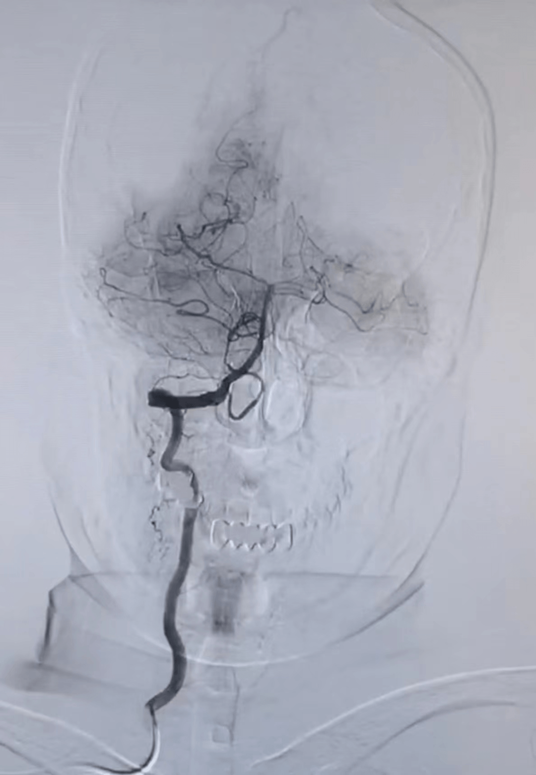 齐医附属一院成功完成首例经桡动脉穿刺行全脑血管造影术_检查_手术