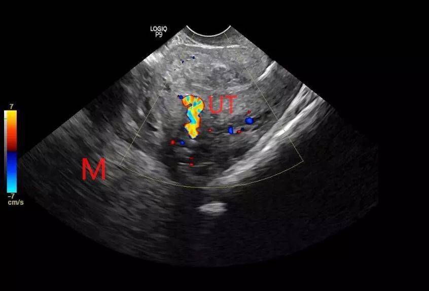 子宫肌瘤 超声诊断并非都是那么容易