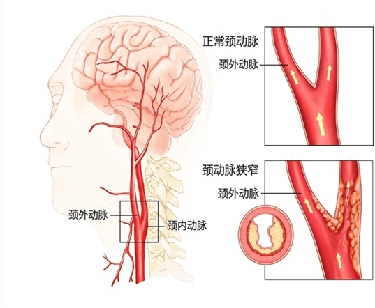 健康科普:体检查出颈动脉斑块怎么办