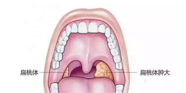 扁桃体是一种淋巴组织,是机体的免疫器官的一部分,有炎症感染时扁桃体
