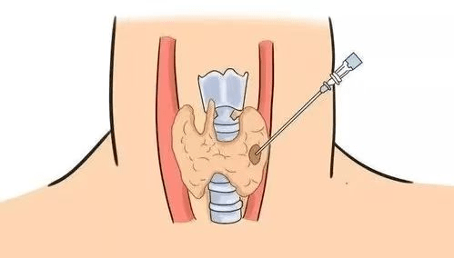 ②甲狀腺囊腫無水酒精硬化治療:甲狀腺囊腫一般不需要治療,但當囊腫較