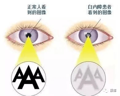 (图源:网络)早期白内障虽然有晶状体混浊,但不足以影响视力,这时可以