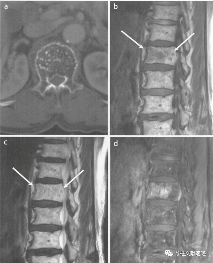 【发病率top3】脊柱脊髓肿瘤典型影像
