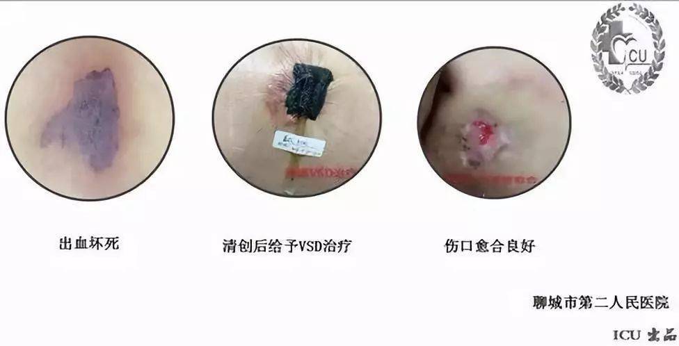 104,16:32因脑出血后遗症期,气管切开术后,肺炎,呼吸衰竭入icu,入室