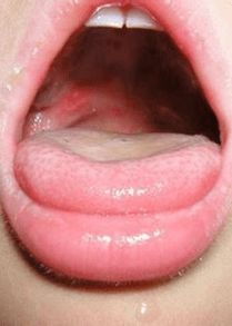 手足口病进入高发期,你需要了解这些→_消毒_进行_传播